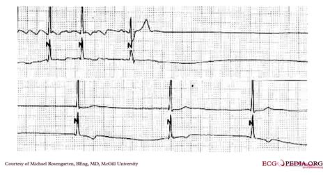 Sick sinus syndrome EKG examples - wikidoc