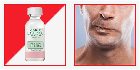 Image result for Pimple From Dry Lips