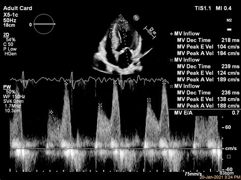 EPIQ CVx Cardiac Ultrasound