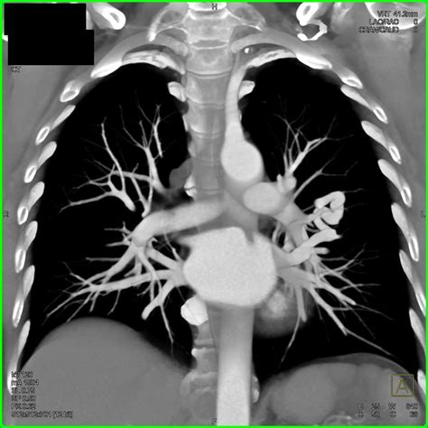 Pulmonary Arteriovenous Malformation (AVM) - Chest Case Studies - CTisus CT Scanning