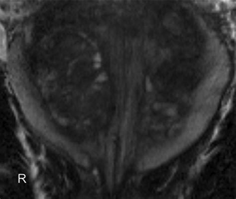 Dynamic Contrast-Enhanced MRI of Prostate Cancer at 3 T: A Study of ...