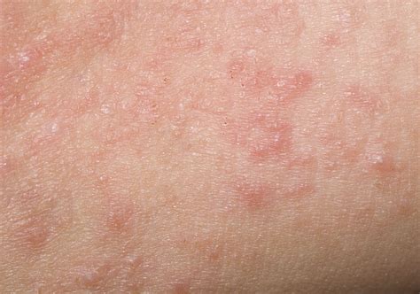 12 Possible Reasons for That Itchy Rash With Blisters