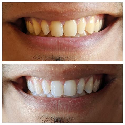 Image result for Colgate White Teeth