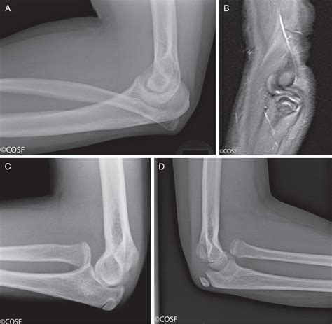Congenital Abnormalities of the Elbow - Clinical Tree