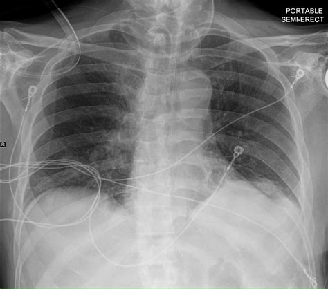 Noncardiogenic Pulmonary Edema Cxr