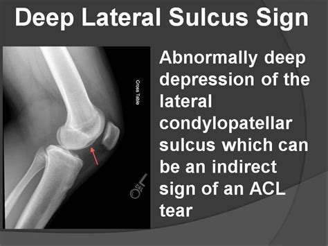 Image result for Sulcus Sign Lateral View