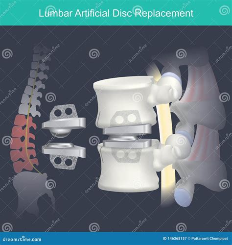 Lumbar Artificial Disc Replacement. Human Bone Anatomy. Stock ...
