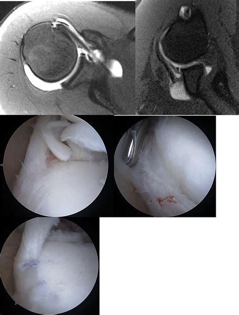 Superior Labral Anterior to Posterior Tears - Orthopedic Clinics