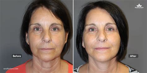 New Thread Lift 的图像结果