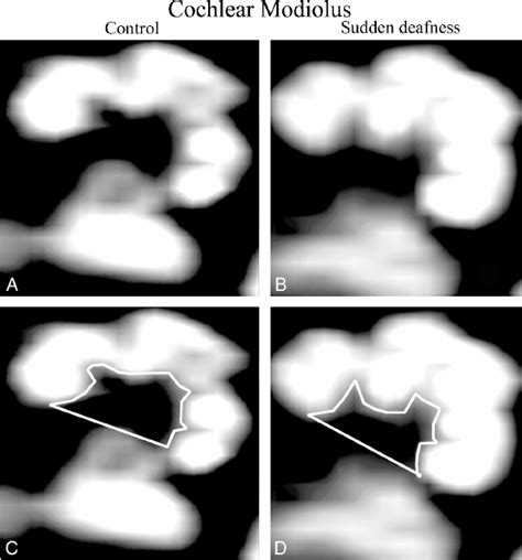 Image result for Modiolus in Cochlea