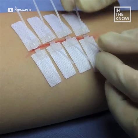 (1) Painless alternative to stitches could make them a thing of the ...