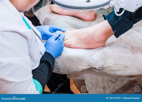 Podology Treatment. Podiatrist Treating Toenail Fungus. Doctor Removes Calluses, Corns and ...