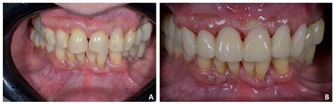 Prosthetically Guided Orthodontics (PGO): A Personalized Clinical ...