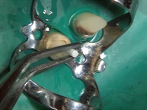 Efficient Preparation Technique for Crowns, Inlays and Cast Root ...