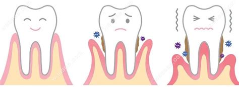 3种类型的「牙髓炎」，照这3个方法治疗，让你拥有健康口腔！