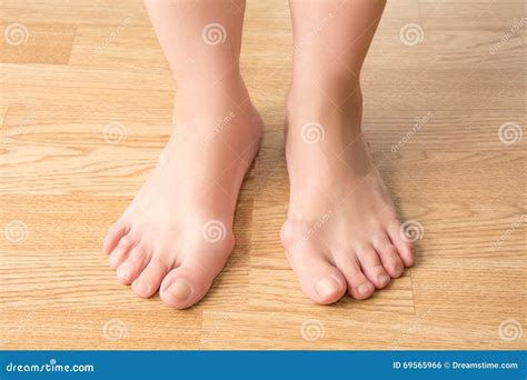 Hallux Valgus, Bunion in Foot, Pain in the Legs Stock Photo - Image of layout, anatomy: 69565966