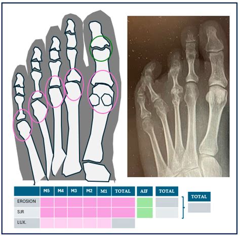 Differences and Similarities in the Feet of Metatarsalgia Patients with ...