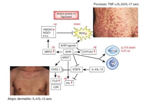 Aryl Hydrocarbon Receptor in Atopic Dermatitis and Psoriasis