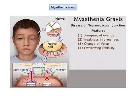 Type II Hypersensitivity-Antibody mediated cytotoxic Hypersensitivity | PDF