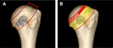 Remplissage in Addition to Arthroscopic Bankart Repair for Shoulder Instability With On-Track ...