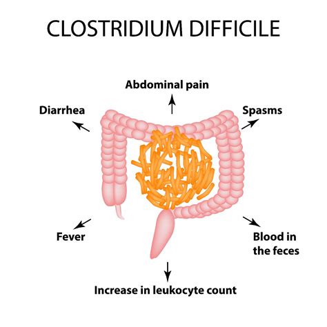 10 Symptoms of Clostridium Difficile Colitis - Facty Health