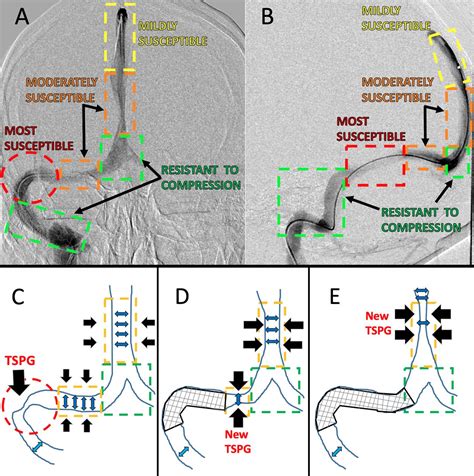 A unifying theory explaining venous sinus stenosis and recurrent ...