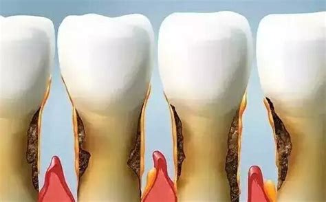 牙齿松动是什么原因导致的？牙齿松动怎么治疗？-牙齿松动怎么办？什么方法可以治疗牙齿松动？
