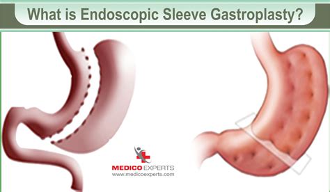 Endoscopic Sleeve Gastroplasty for Weight Loss