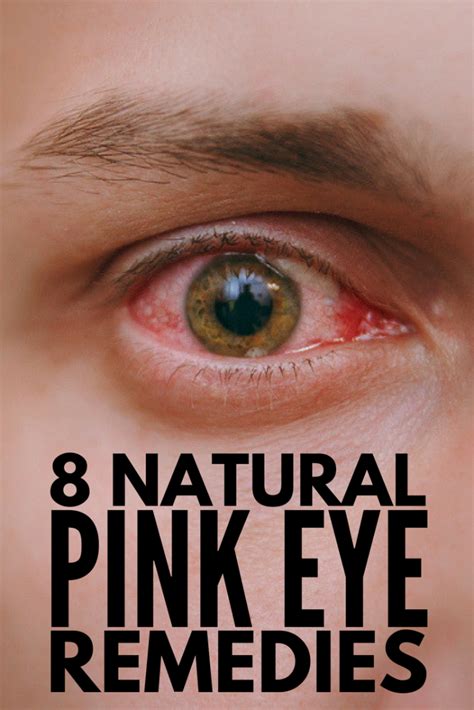 Home Remedies for Pink Eye: 8 Natural Remedies for Pink Eye that Work!
