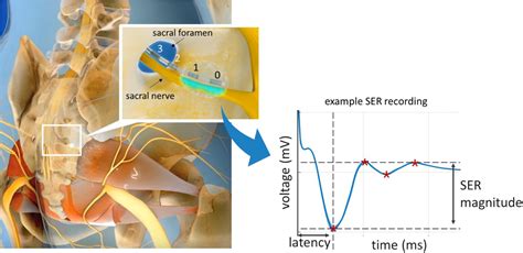 Sensing in Sacral Neuromodulation: A Feasibility Study in Subjects With ...