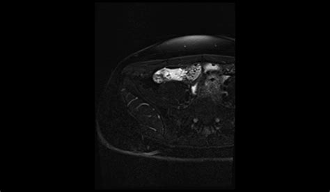 Image result for Normal Appendix MRI