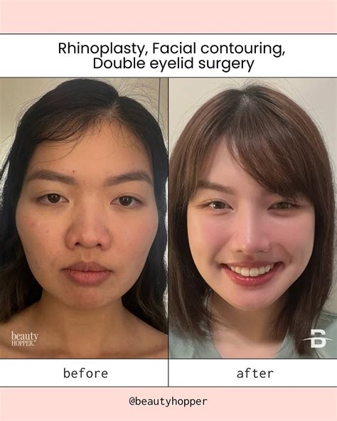 Plastic Surgery in Korea: Medical Tourism Concierge in 2025 | Face surgery, Plastic surgery ...