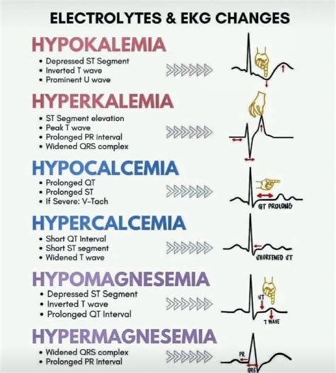 Visual for ecg changes for different electrolyte imbalances – Artofit