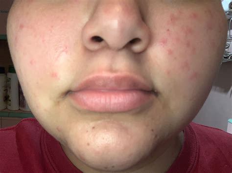 red spots on my face (not acne) - Beauty Insider Community