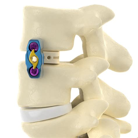 Canwell Spine Bone Graft Implant Orthopedic Olif Oblique Lumbar Interbody Fusion Peek Cage ...