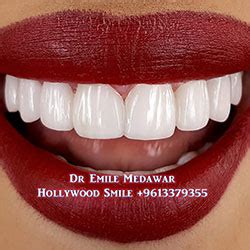 Hollywood Smile Lebanon | Emax Veneers Lebanon