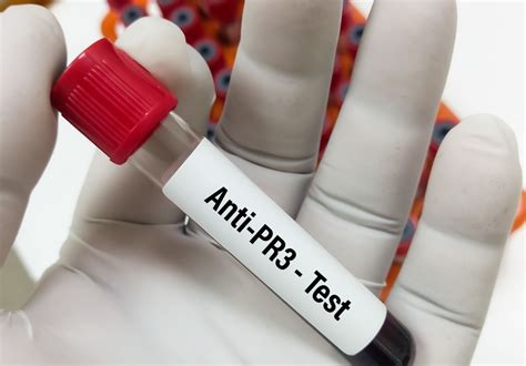 Benralizumab Proven Effective for Rare Vasculitis Treatment - - Global Neurology Academy