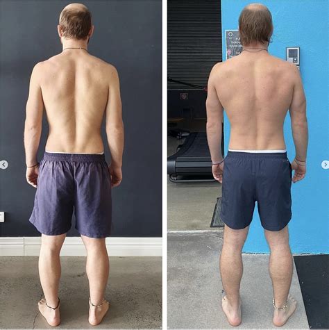 How to heal a bulging disc naturally — Functional Patterns Brisbane