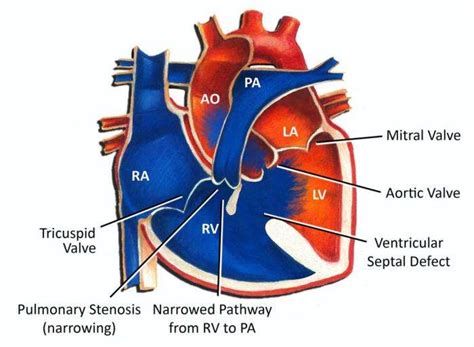 Post-Surgery Care for Tetralogy of Fallot Patients