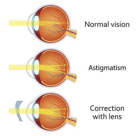 Astigmatism: What is it? - Pacific Vision Institute Articles
