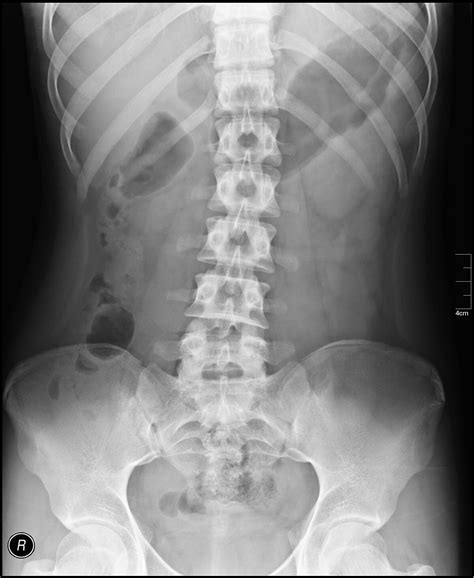 X Ray For Abdomen