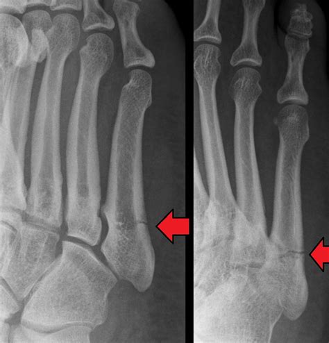 Can you walk on a hairline fracture foot?