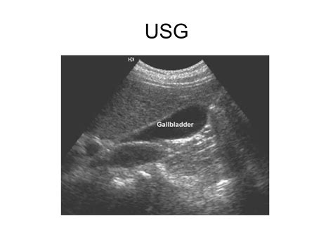 Anatomy of gall bladder | PPTX