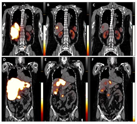Impressive Response to TANDEM Peptide Receptor Radionuclide Therapy ...