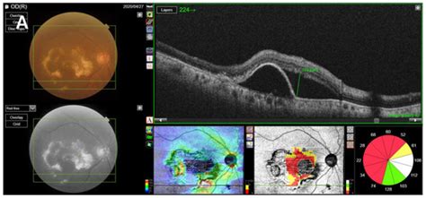 Impact of Delayed Intravitreal Anti-Vascular Endothelial Growth Factor ...