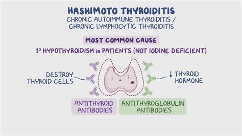 Hashimoto thyroiditis: Clinical sciences - Osmosis Video Library - new treatments for hashimoto's thyroiditis