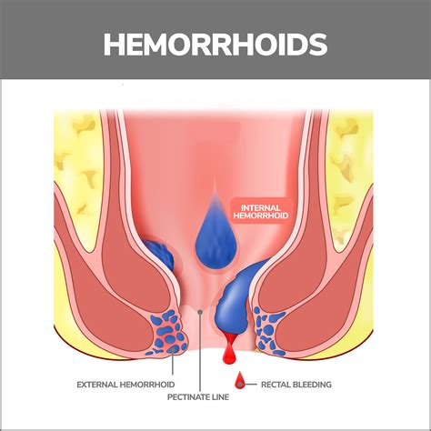 Should You Pop A Hemorrhoid