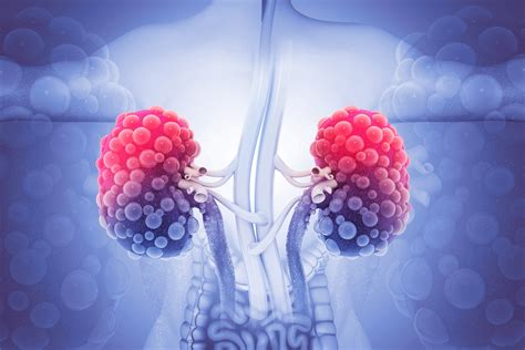 Autosomal Dominant Polycystic Kidney Disease (ADPKD) - CARE