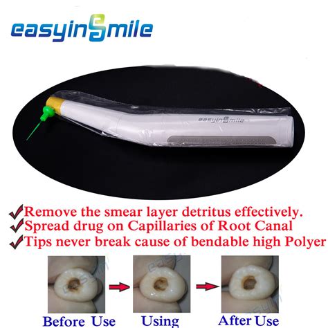 Buy endo sonic activator 60 soft tips Ultra irrigator for 3D endo root ...