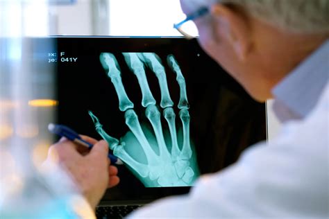 Rheumatoid Arthritis Symptoms You Shouldn't Ignore at Cassandra Wasinger blog